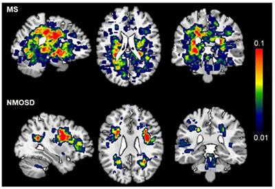 Cortical Thinning and Ventricle Enlargement in Neuromyelitis Optica Spectrum Disorders